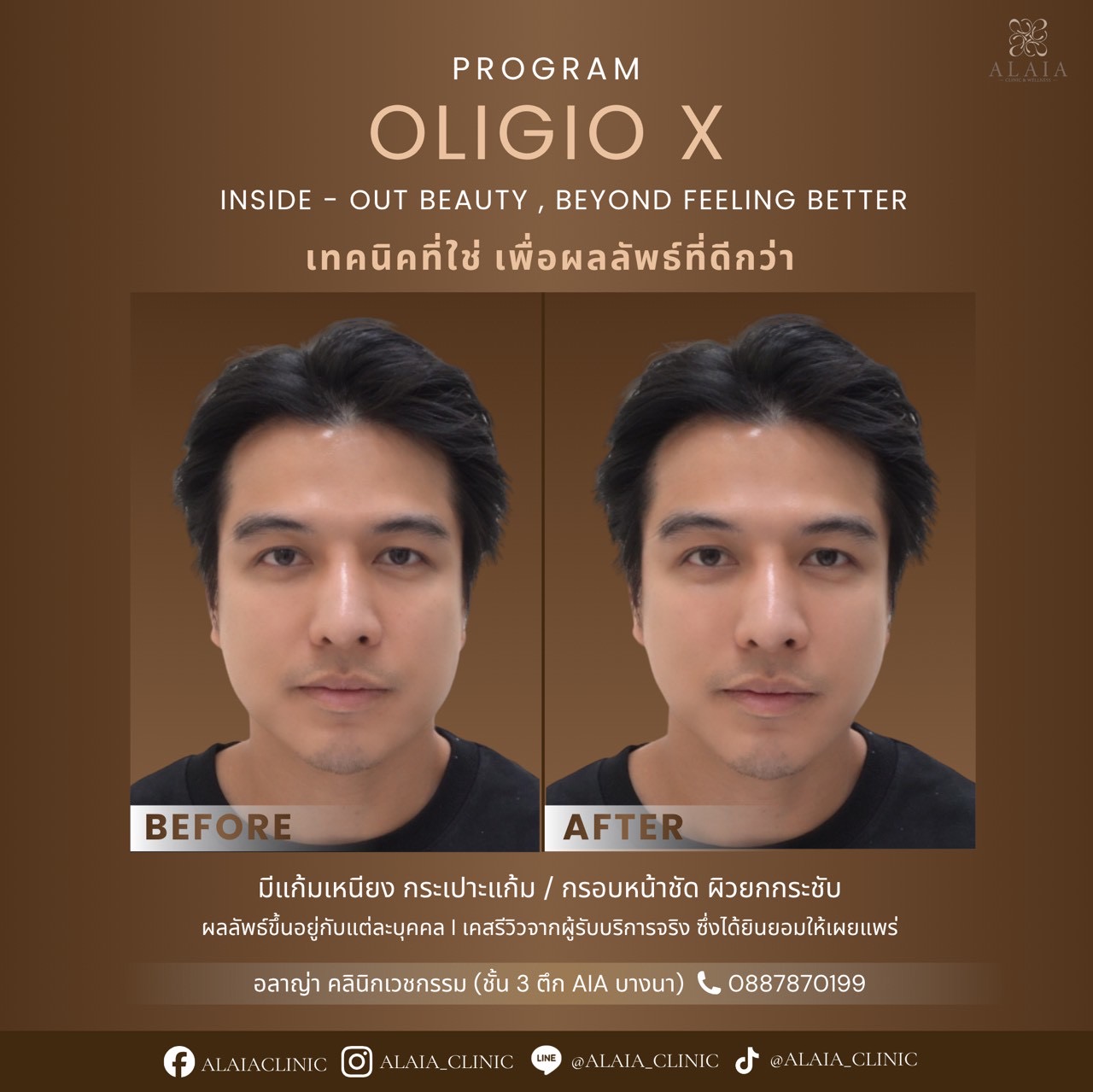 Oligio X Real Result 3